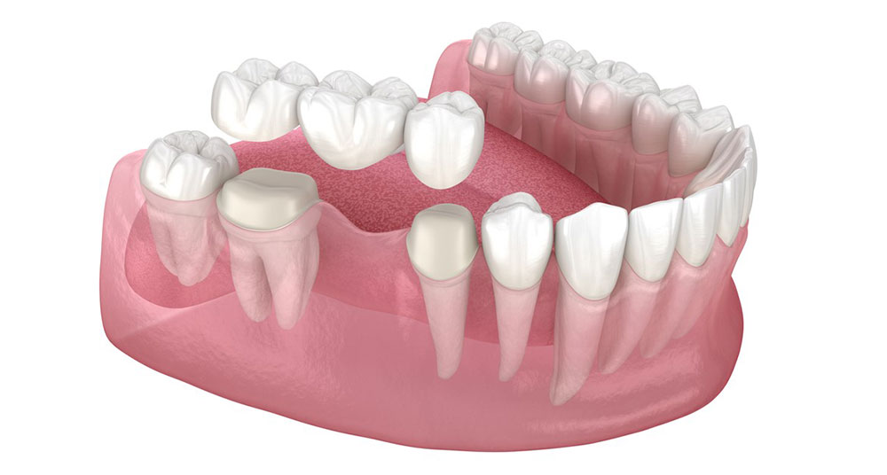 caring-for-your-dental-restorations