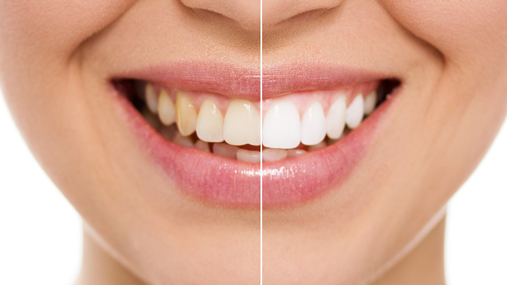 professional-teeth-whitening